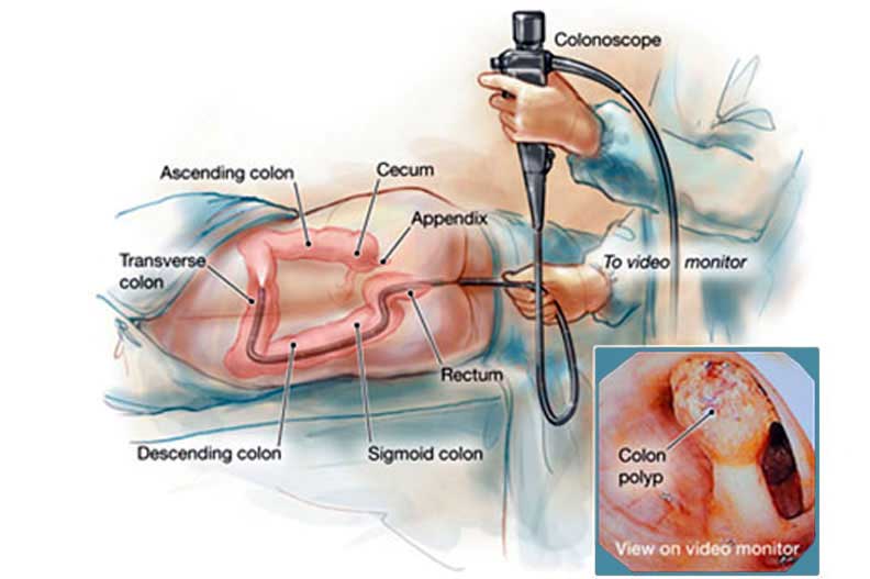 Colonoscopia (endoscopia digestiva inferioara) | Provita